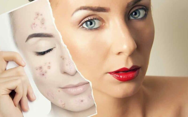 Qual é o melhor tratamento para clarear manchas de pele?