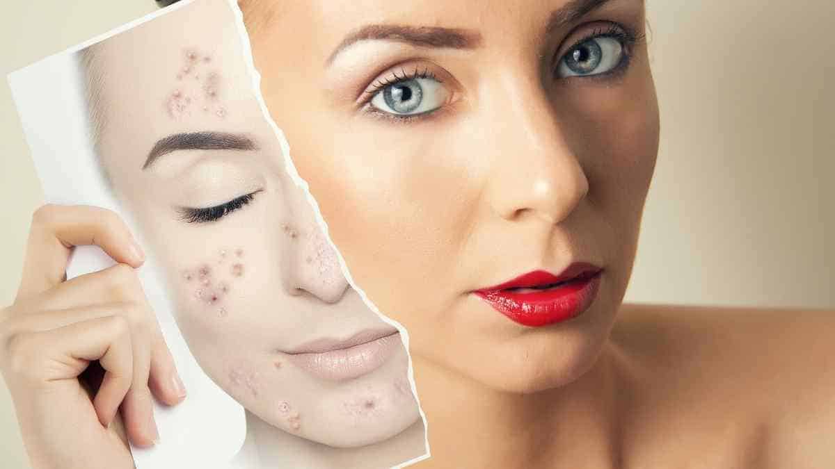 Qual é o melhor tratamento para clarear manchas de pele?